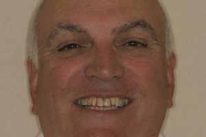 Jeff, Before Cosmetic Crowns | Concord, NC