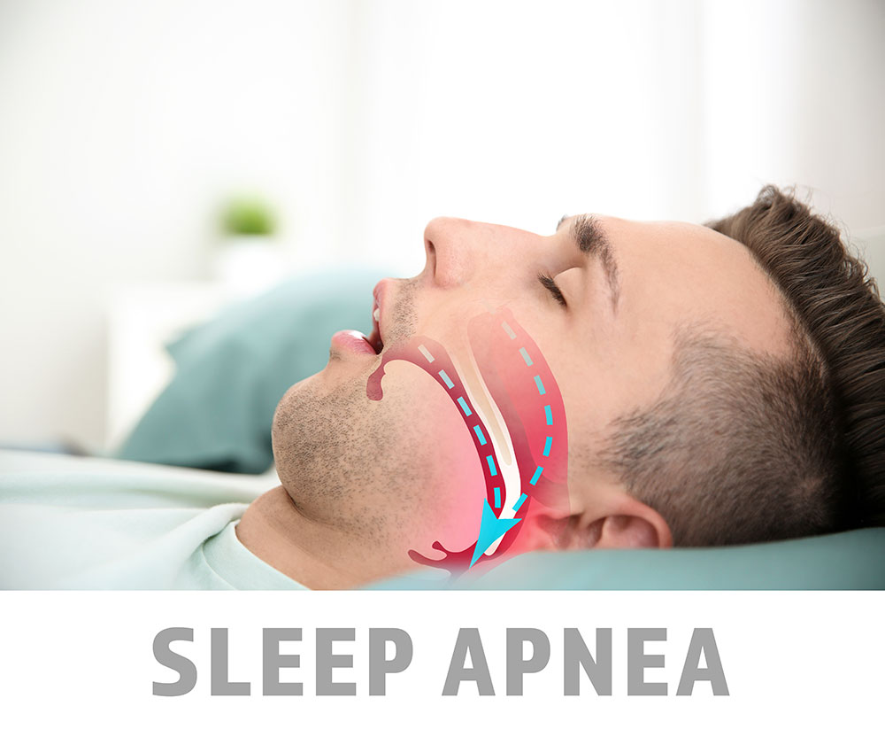 What is Sleep Apnea?