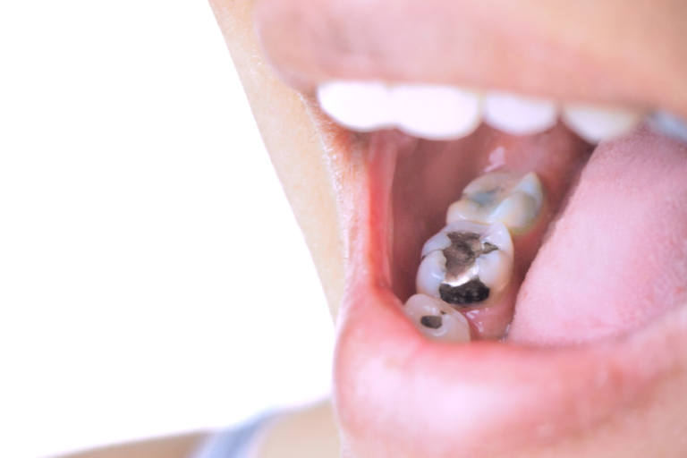 Should Metal Fillings Be Replaced With Composites 