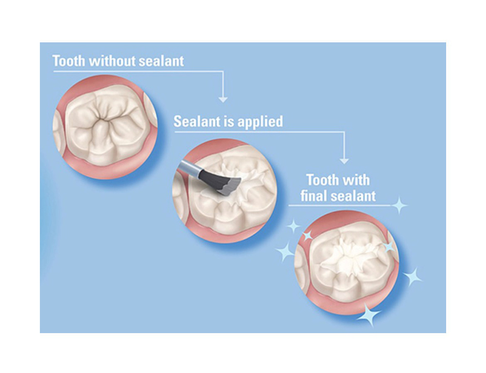 What Are Dental Sealants and How Do They Help?